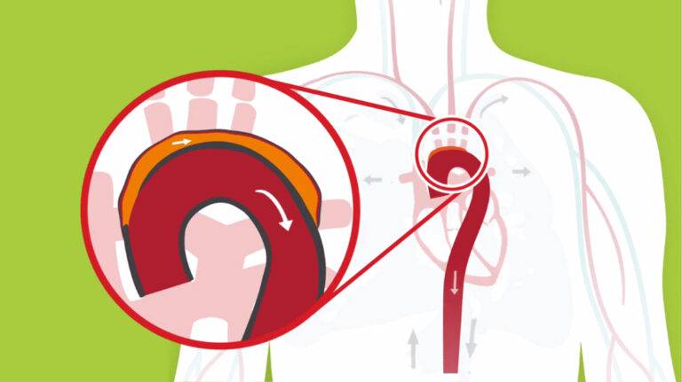 Aorta